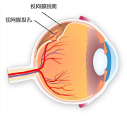 揉眼睛時出現(xiàn)閃光感是怎么回事？注意！可能是視網(wǎng)膜脫離！
